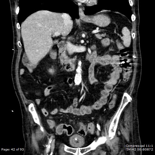 Adrenal metastasis (Radiopaedia 78425-91079 Sagittal C+ portal venous phase 29).jpg