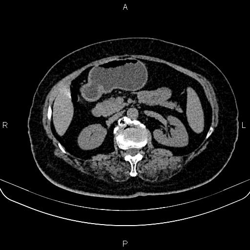 Adrenal myelolipoma (Radiopaedia 82742-96986 Axial non-contrast 63).jpg