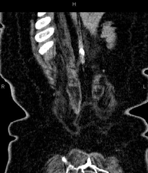 Adrenal myelolipoma (Radiopaedia 82742-96986 Coronal renal cortical phase 72).jpg