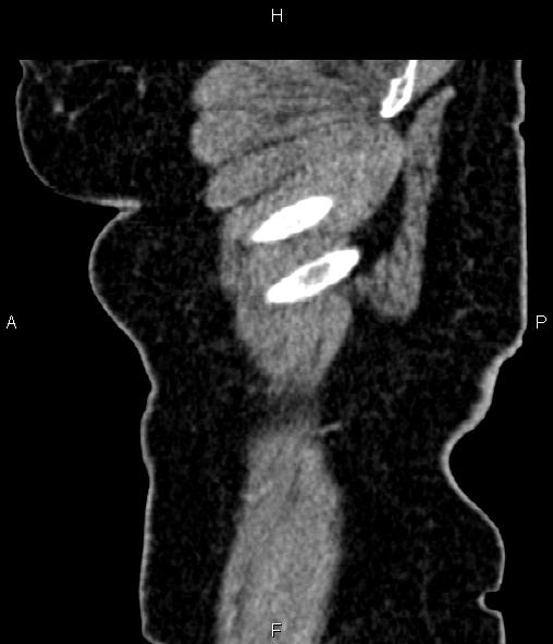 Adrenal myelolipoma (Radiopaedia 82742-96986 Sagittal renal cortical phase 13).jpg