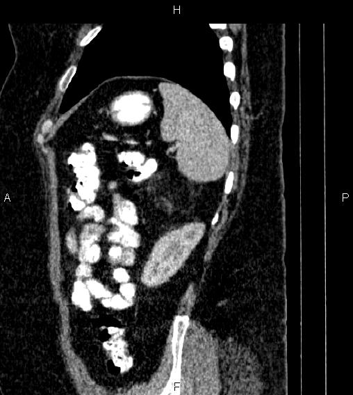 Adrenal myelolipoma (Radiopaedia 84319-99617 Sagittal renal cortical phase 80).jpg