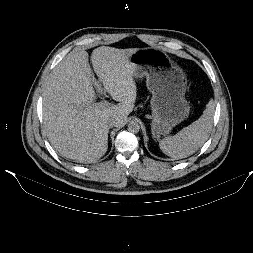 Adrenal myelolipoma (Radiopaedia 84321-99619 Axial non-contrast 25).jpg