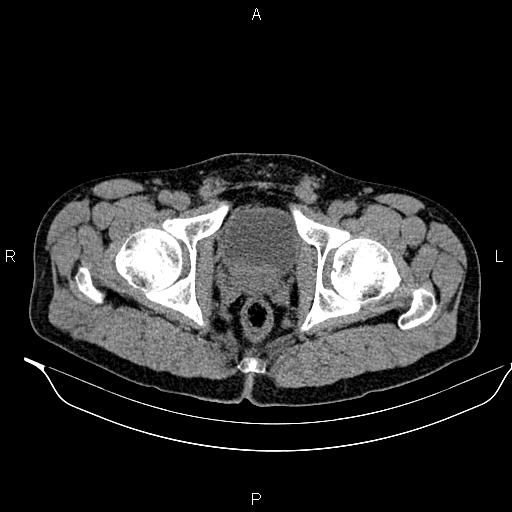 Adrenal myelolipoma (Radiopaedia 87794-104246 Axial non-contrast 104).jpg