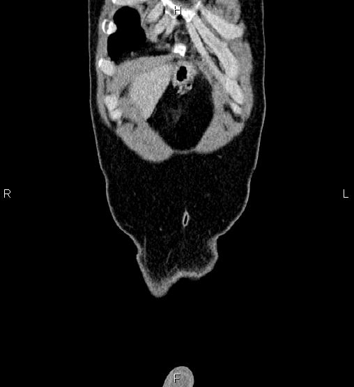File:Adrenal myelolipoma (Radiopaedia 87794-104246 Coronal renal cortical phase 2).jpg