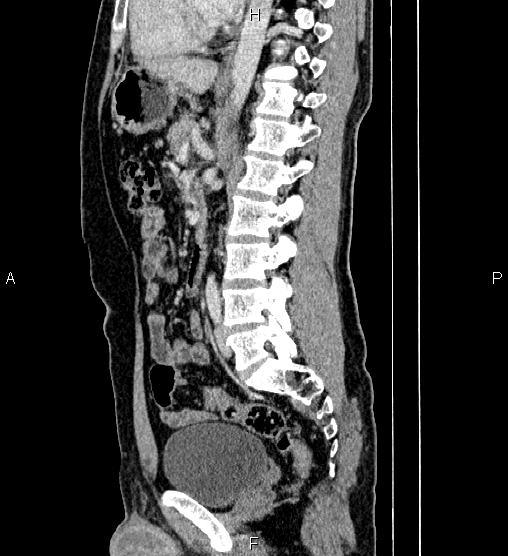 Adrenal myelolipoma (Radiopaedia 87794-104246 Sagittal renal cortical phase 53).jpg