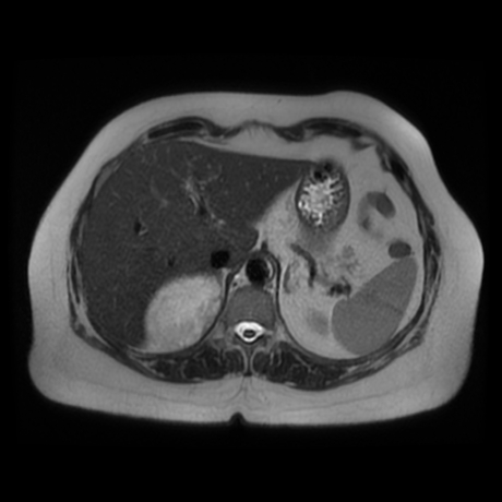 File:Adrenal myelolipoma - MRI (Radiopaedia 83249-97646 Axial T2 11).jpg
