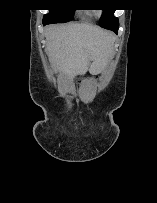Adrenal myelolipoma - bilateral (Radiopaedia 74805-85810 Coronal C+ portal venous phase 233).jpg
