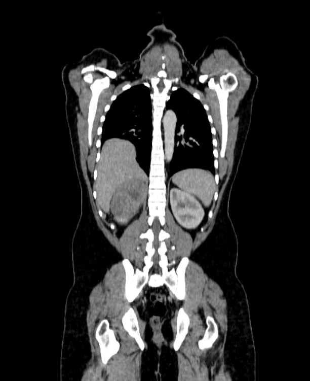 Adrenocortical carcinoma (Radiopaedia 80134-93438 Coronal C+ portal venous phase 119).jpg