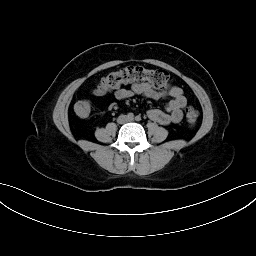 Adrenocortical carcinoma (Radiopaedia 87281-103569 Axial non-contrast 53).jpg