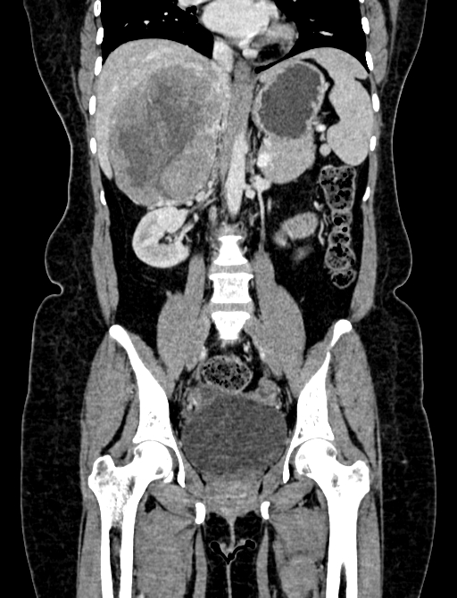 Adrenocortical carcinoma (Radiopaedia 87281-103569 Coronal C+ portal venous phase 57).jpg