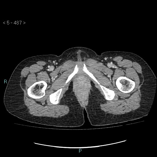 Adult transient intestinal intussusception (Radiopaedia 34853-36310 Axial C+ portal venous phase 133).jpg