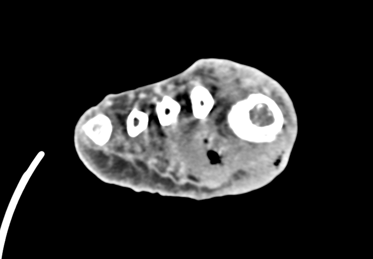 Advanced osteomyelitis due to open metatarsal fracture (Radiopaedia 83891-99095 Axial non-contrast 37).jpg