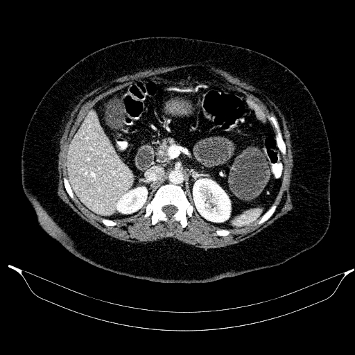 Afferent loop syndrome - secondary to incarcerated trocar site hernia (Radiopaedia 82959-97305 Axial C+ portal venous phase 81).jpg