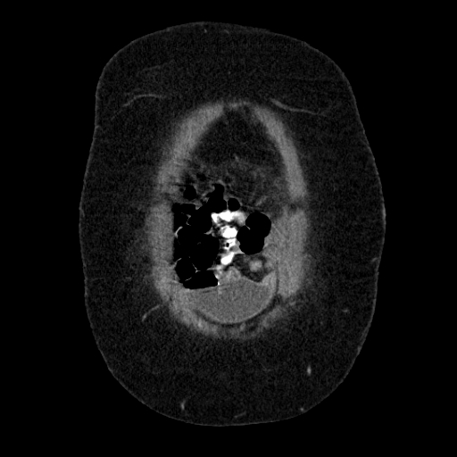 File:Afferent loop syndrome - secondary to incarcerated trocar site hernia (Radiopaedia 82959-97305 Coronal C+ portal venous phase 28).jpg
