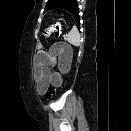 File:Afferent loop syndrome - secondary to incarcerated trocar site hernia (Radiopaedia 82959-97305 Sagittal C+ portal venous phase 29).jpg