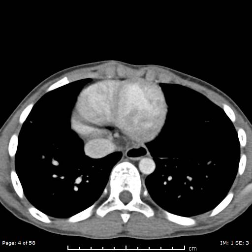 File:Agenesis of the gallbladder (Radiopaedia 55454-61905 Axial 53).jpg