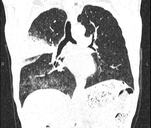 File:Air bronchogram in pneumonia (Radiopaedia 85719-101512 Coronal lung window 32).jpg