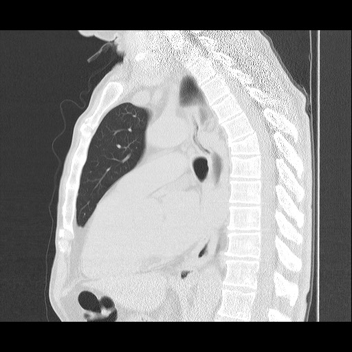 Allergic bronchopulmonary aspergillosis (ABPA) (Radiopaedia 60594-68313 Sagittal lung window 28).jpg