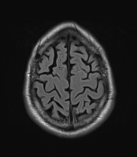 File:Alzheimer's disease- with Gerstmann syndrome and dressing apraxia (Radiopaedia 54882-61150 Axial FLAIR 24).png