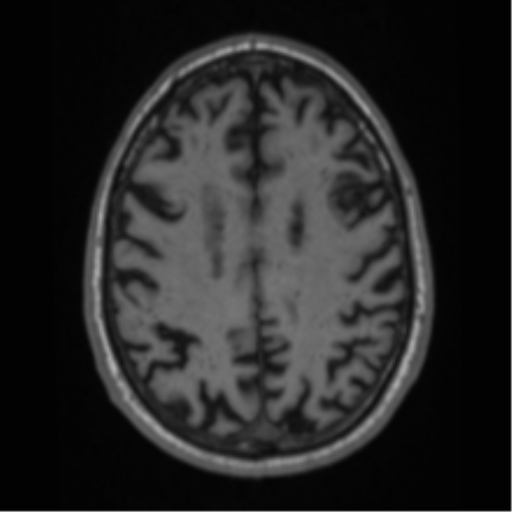 File:Alzheimer's disease- with Gerstmann syndrome and dressing apraxia (Radiopaedia 54882-61150 Axial T1 53).png