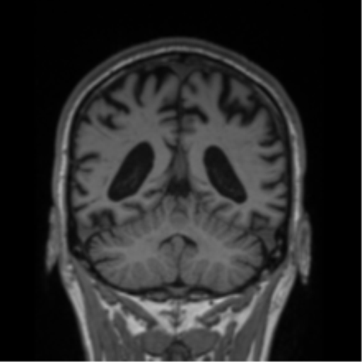 Alzheimer's disease- with Gerstmann syndrome and dressing apraxia (Radiopaedia 54882-61150 Coronal T1 29).png