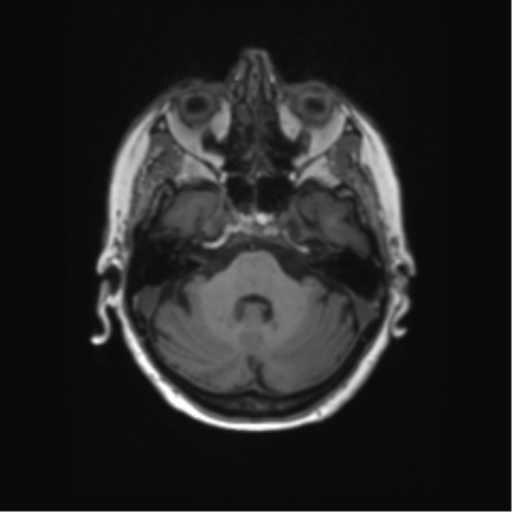 File:Alzheimer's disease (Radiopaedia 42658-45802 Axial T1 115).png