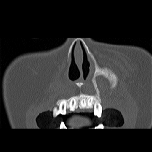 File:Ameloblastic fibro-odontoma (Radiopaedia 18843-18780 B 5).jpg