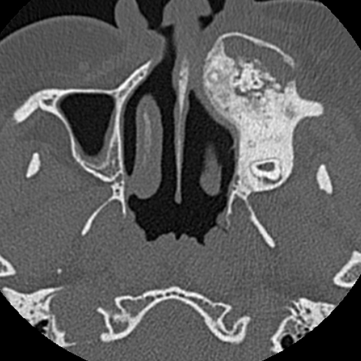 File:Ameloblastic fibro-odontoma (Radiopaedia 18843-18780 C 27).jpg