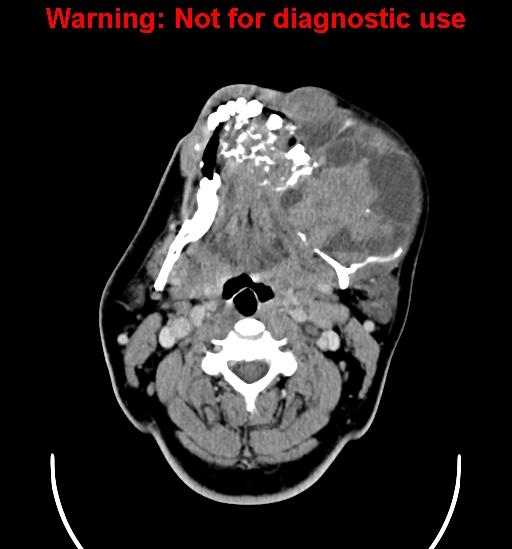 File:Ameloblastoma (Radiopaedia 33126-34164 B 10).jpg