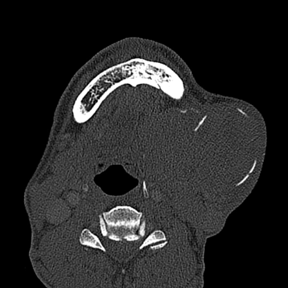 Ameloblastoma (Radiopaedia 51921-57766 Axial bone window 33).jpg