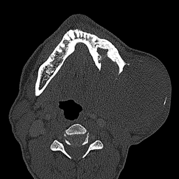 Ameloblastoma (Radiopaedia 51921-57766 Axial bone window 55).jpg