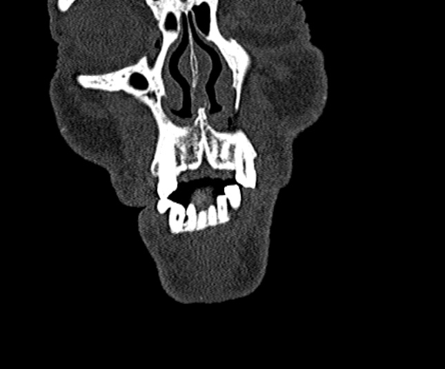 Ameloblastoma (Radiopaedia 51921-57766 Coronal bone window 22).jpg