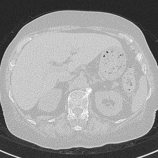 Amiodarone-induced pulmonary fibrosis (Radiopaedia 82355-96460 Axial lung window 71).jpg