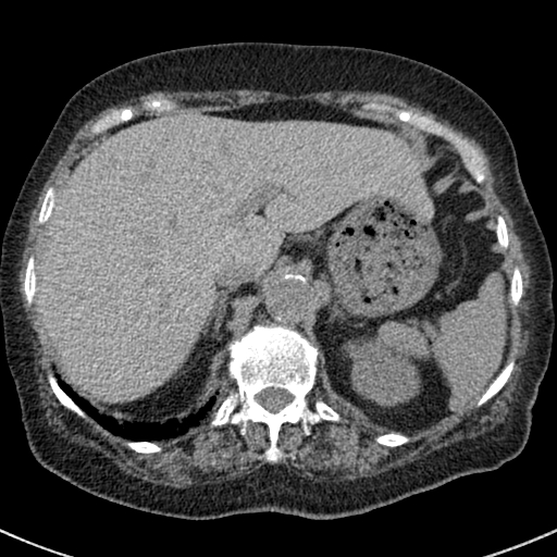 File:Amiodarone-induced pulmonary fibrosis (Radiopaedia 82355-96460 Axial non-contrast 56).jpg