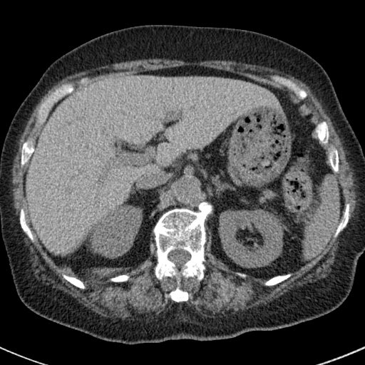 File:Amiodarone-induced pulmonary fibrosis (Radiopaedia 82355-96460 Axial non-contrast 60).jpg