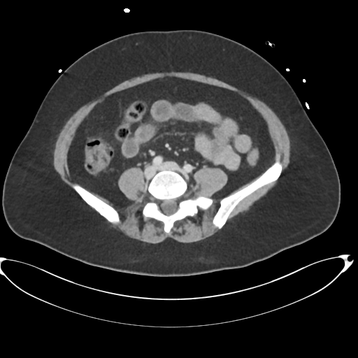 File:Amoebic liver abscess (Radiopaedia 52611-58530 A 65).png