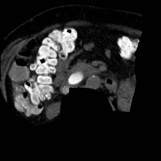 Ampullary adenocarcinoma (Radiopaedia 34013-35241 AXIAL MIPS 3-1.5 85).png