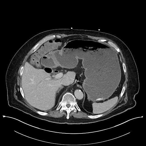 Ampullary adenocarcinoma (Radiopaedia 59373-66737 A 41).jpg