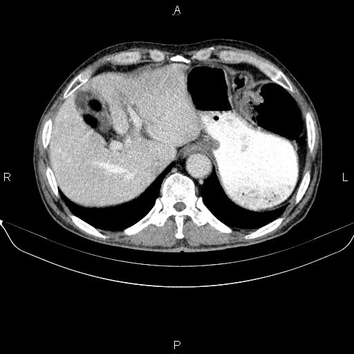 Ampullary adenocarcinoma (Radiopaedia 86093-102032 A 12).jpg