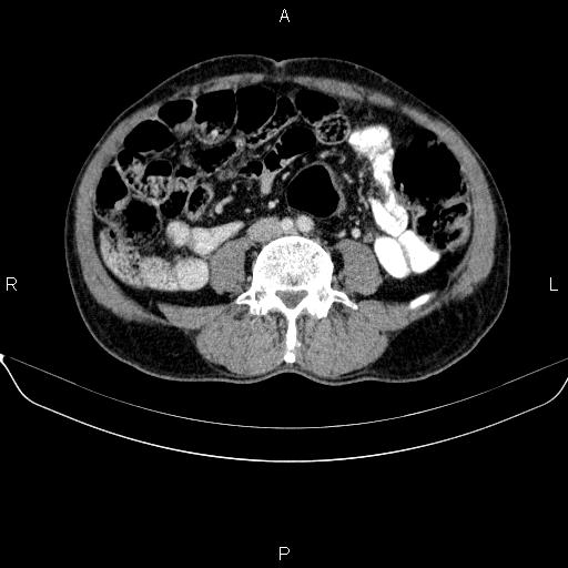 Ampullary adenocarcinoma (Radiopaedia 86093-102032 A 36).jpg