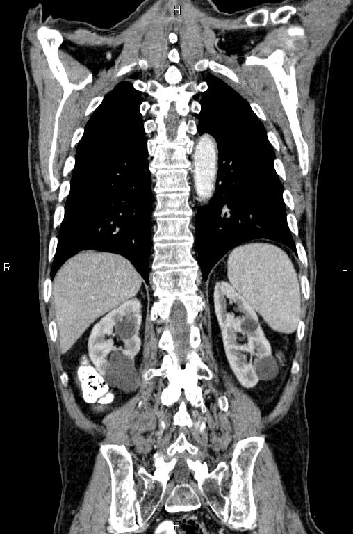 Ampullary adenocarcinoma (Radiopaedia 86093-102033 D 47).jpg