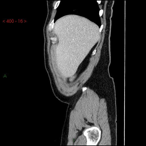 Ampullary carcinoma (Radiopaedia 56396-63056 D 15).jpg