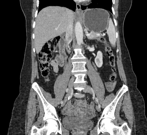 Ampullary tumor (Radiopaedia 60333-67998 B 43).jpg