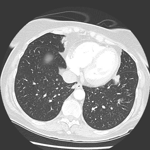 Amyloidosis - bronchial and diffuse nodular pulmonary involvement (Radiopaedia 60156-67745 Axial lung window 62).jpg