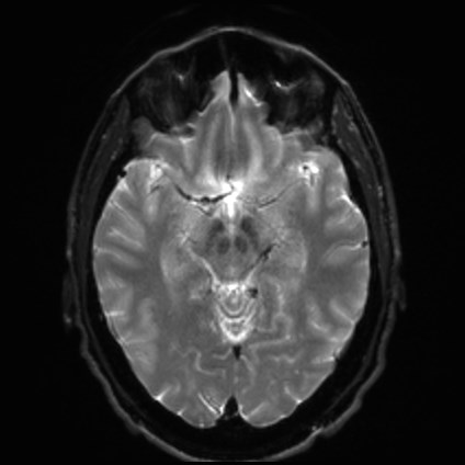File:Amyotrophic lateral sclerosis (Radiopaedia 87352-103658 Axial DWI 11).jpg