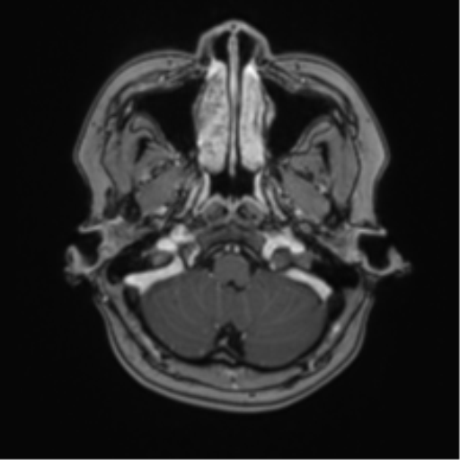 Anaplastic astroblastoma (Radiopaedia 55666-62194 Axial T1 C+ 11).png
