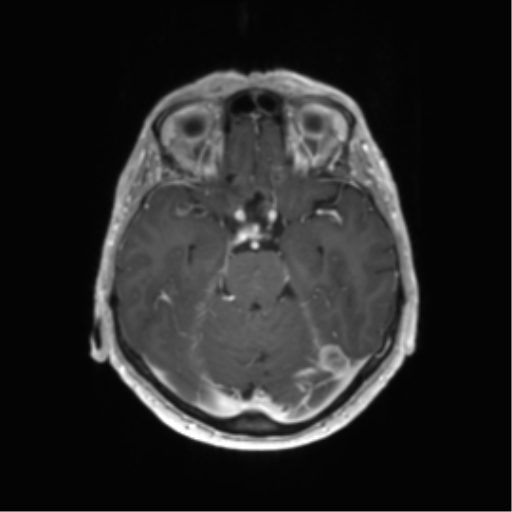 File:Anaplastic astrocytoma (Radiopaedia 86943-103160 Axial T1 C+ 7).png