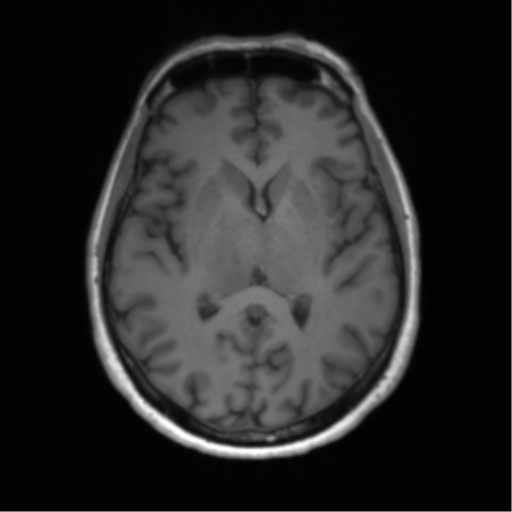 File:Anaplastic astrocytoma - thalamic glioma (Radiopaedia 59709-67115 Axial T1 16).png