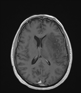 File:Anaplastic astrocytoma IDH wild-type (Radiopaedia 49984-55273 Axial T1 C+ 34).png
