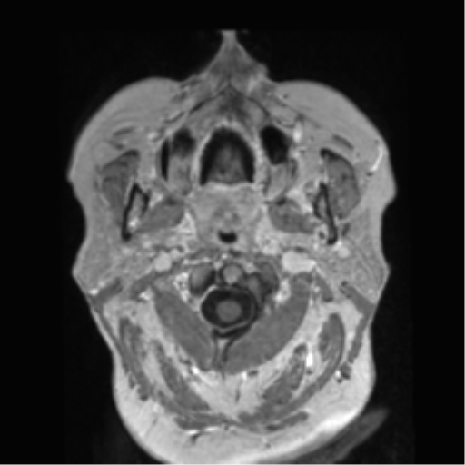 Anaplastic astrocytoma IDH wild-type (pseudoprogression) (Radiopaedia 42209-45278 Axial T1 C+ 8).png